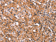 The image on the left is immunohistochemistry of paraffin-embedded Human thyroid cancer tissue using CSB-PA657855(MAPK11 Antibody) at dilution 1/30, on the right is treated with synthetic peptide. (Original magnification: ×200)