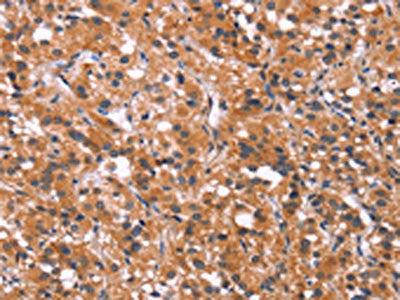 The image on the left is immunohistochemistry of paraffin-embedded Human thyroid cancer tissue using CSB-PA657855(MAPK11 Antibody) at dilution 1/30, on the right is treated with synthetic peptide. (Original magnification: ×200)