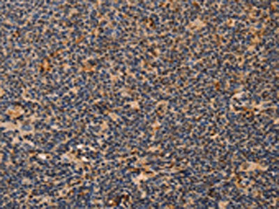 The image on the left is immunohistochemistry of paraffin-embedded Human Lymphoma tissue using CSB-PA658038(MPG Antibody) at dilution 1/40, on the right is treated with fusion protein. (Original magnification: ×200)