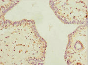 Immunohistochemistry of paraffin-embedded human breast cancer using CSB-PA658362ESR1HU at dilution of 1:100