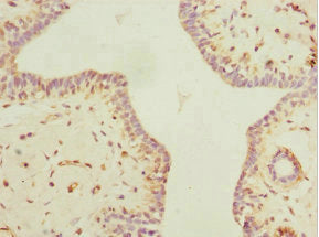 Immunohistochemistry of paraffin-embedded human breast cancer using CSB-PA658362ESR1HU at dilution of 1:100