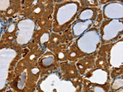 The image on the left is immunohistochemistry of paraffin-embedded Human thyroid cancer tissue using CSB-PA660209(RAB27A Antibody) at dilution 1/30, on the right is treated with fusion protein. (Original magnification: ×200)