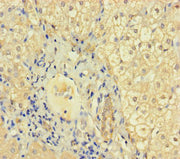 Immunohistochemistry of paraffin-embedded human liver cancer using CSB-PA660951LA01HU at dilution of 1:100