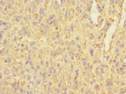 Immunohistochemistry of paraffin-embedded human melanoma using CSB-PA662245LA01HU at dilution of 1:100