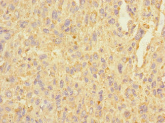 Immunohistochemistry of paraffin-embedded human melanoma using CSB-PA662245LA01HU at dilution of 1:100