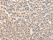 The image on the left is immunohistochemistry of paraffin-embedded Human liver cancer tissue using CSB-PA662359(VPS45 Antibody) at dilution 1/35, on the right is treated with fusion protein. (Original magnification: ×200)