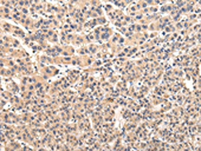 The image on the left is immunohistochemistry of paraffin-embedded Human liver cancer tissue using CSB-PA662359(VPS45 Antibody) at dilution 1/35, on the right is treated with fusion protein. (Original magnification: ×200)
