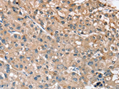 The image on the left is immunohistochemistry of paraffin-embedded Human liver cancer tissue using CSB-PA663638(RRAS Antibody) at dilution 1/30, on the right is treated with synthetic peptide. (Original magnification: ×200)