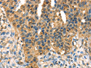 The image on the left is immunohistochemistry of paraffin-embedded Human breast cancer tissue using CSB-PA663869(DHCR24 Antibody) at dilution 1/35, on the right is treated with fusion protein. (Original magnification: ×200)