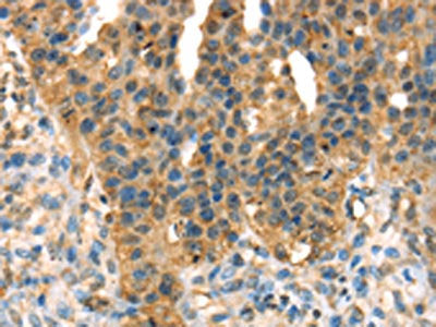 The image on the left is immunohistochemistry of paraffin-embedded Human breast cancer tissue using CSB-PA663869(DHCR24 Antibody) at dilution 1/35, on the right is treated with fusion protein. (Original magnification: ×200)