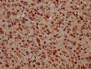 IHC image of CSB-PA664240LA01HU diluted at 1:500 and staining in paraffin-embedded human glioma performed on a Leica BondTM system. After dewaxing and hydration, antigen retrieval was mediated by high pressure in a citrate buffer (pH 6.0). Section...