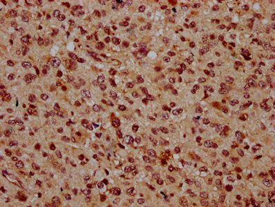 IHC image of CSB-PA664240LA01HU diluted at 1:500 and staining in paraffin-embedded human glioma performed on a Leica BondTM system. After dewaxing and hydration, antigen retrieval was mediated by high pressure in a citrate buffer (pH 6.0). Section...
