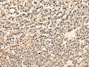 The image on the left is immunohistochemistry of paraffin-embedded Human liver cancer tissue using CSB-PA664720(VPS37D Antibody) at dilution 1/30, on the right is treated with fusion protein. (Original magnification: ×200)