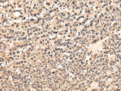 The image on the left is immunohistochemistry of paraffin-embedded Human liver cancer tissue using CSB-PA664720(VPS37D Antibody) at dilution 1/30, on the right is treated with fusion protein. (Original magnification: ×200)