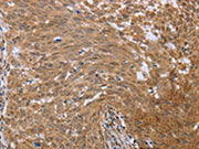The image on the left is immunohistochemistry of paraffin-embedded Human cervical cancer tissue using CSB-PA664930(FHL2 Antibody) at dilution 1/40, on the right is treated with fusion protein. (Original magnification: ×200)