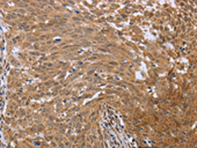 The image on the left is immunohistochemistry of paraffin-embedded Human cervical cancer tissue using CSB-PA664930(FHL2 Antibody) at dilution 1/40, on the right is treated with fusion protein. (Original magnification: ×200)