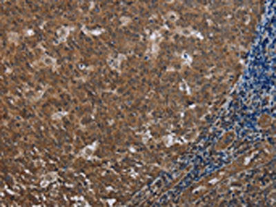 The image on the left is immunohistochemistry of paraffin-embedded Human tonsil tissue using CSB-PA665086(FOLH1B Antibody) at dilution 1/20, on the right is treated with synthetic peptide. (Original magnification: ×200)