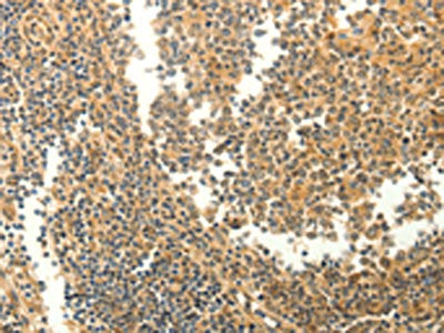 The image on the left is immunohistochemistry of paraffin-embedded Human tonsil tissue using CSB-PA665912(MYH7 Antibody) at dilution 1/20, on the right is treated with fusion protein. (Original magnification: ×200)