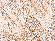 The image on the left is immunohistochemistry of paraffin-embedded Human gastic cancer tissue using CSB-PA665979(AMD1 Antibody) at dilution 1/20, on the right is treated with synthetic peptide. (Original magnification: ×200)