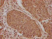 IHC image of CSB-PA666060LA01HU diluted at 1:100 and staining in paraffin-embedded human cervical cancer performed on a Leica BondTM system. After dewaxing and hydration, antigen retrieval was mediated by high pressure in a citrate buffer (pH 6.0)...