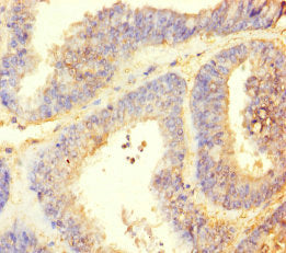 Immunohistochemistry of paraffin-embedded human endometrial cancer using CSB-PA667484LA01HU at dilution of 1:100
