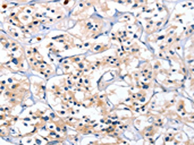 The image on the left is immunohistochemistry of paraffin-embedded Human thyroid cancer tissue using CSB-PA669752(CATSPER1 Antibody) at dilution 1/40, on the right is treated with fusion protein. (Original magnification: ×200)