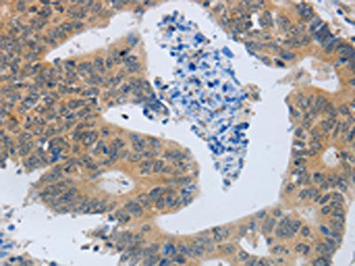 The image is immunohistochemistry of paraffin-embedded Human colon cancer tissue using CSB-PA670355(MMP8 Antibody) at dilution 1/45. (Original magnification: ×200)
