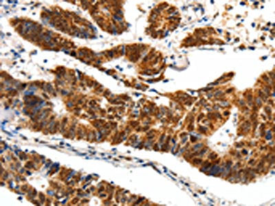 The image on the left is immunohistochemistry of paraffin-embedded Human colon cancer tissue using CSB-PA671453(SP1 Antibody) at dilution 1/40, on the right is treated with synthetic peptide. (Original magnification: ×200)