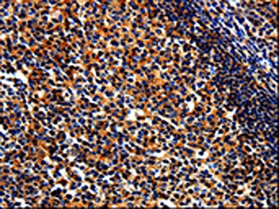 The image on the left is immunohistochemistry of paraffin-embedded Human tonsil tissue using CSB-PA671607(BIRC6 Antibody) at dilution 1/50, on the right is treated with synthetic peptide. (Original magnification: ×200)