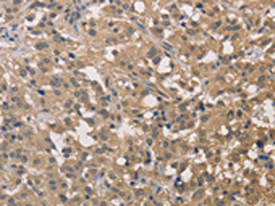 The image on the left is immunohistochemistry of paraffin-embedded Human thyroid cancer tissue using CSB-PA671890(DSTN Antibody) at dilution 1/30, on the right is treated with fusion protein. (Original magnification: ×200)