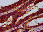 IHC image of CSB-PA672326LA01HU diluted at 1:300 and staining in paraffin-embedded human colon cancer performed on a Leica BondTM system. After dewaxing and hydration, antigen retrieval was mediated by high pressure in a citrate buffer (pH 6.0). S...