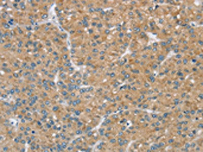 The image on the left is immunohistochemistry of paraffin-embedded Human liver cancer tissue using CSB-PA672900(SENP3 Antibody) at dilution 1/20, on the right is treated with synthetic peptide. (Original magnification: ×200)