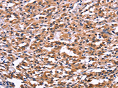 The image on the left is immunohistochemistry of paraffin-embedded Human thyroid cancer tissue using CSB-PA673833(USP2 Antibody) at dilution 1/30, on the right is treated with fusion protein. (Original magnification: ×200)