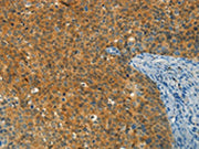 The image on the left is immunohistochemistry of paraffin-embedded Human cervical cancer tissue using CSB-PA674975(DIRAS1 Antibody) at dilution 1/30, on the right is treated with synthetic peptide. (Original magnification: ×200)
