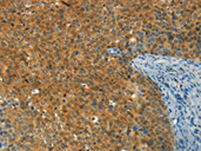 The image on the left is immunohistochemistry of paraffin-embedded Human cervical cancer tissue using CSB-PA674975(DIRAS1 Antibody) at dilution 1/30, on the right is treated with synthetic peptide. (Original magnification: ×200)