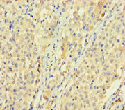 Immunohistochemistry of paraffin-embedded human lung cancer using CSB-PA676576LA01HU at dilution of 1:100