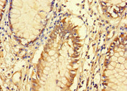 Immunohistochemistry of paraffin-embedded human colon cancer using CSB-PA677719LA01HU at dilution of 1:100