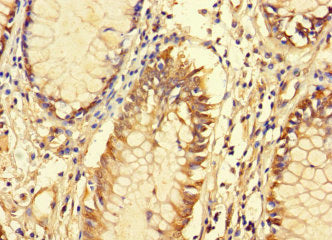 Immunohistochemistry of paraffin-embedded human colon cancer using CSB-PA677719LA01HU at dilution of 1:100