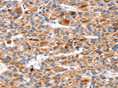 The image on the left is immunohistochemistry of paraffin-embedded Human liver cancer tissue using CSB-PA678002(KCNH6 Antibody) at dilution 1/30, on the right is treated with fusion protein. (Original magnification: ×200)