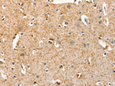 The image on the left is immunohistochemistry of paraffin-embedded Human brain tissue using CSB-PA678542(BRCA1 Antibody) at dilution 1/25, on the right is treated with fusion protein. (Original magnification: ×200)
