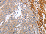 The image on the left is immunohistochemistry of paraffin-embedded Human ovarian cancer tissue using CSB-PA678879(NRTN Antibody) at dilution 1/60, on the right is treated with synthetic peptide. (Original magnification: ×200)