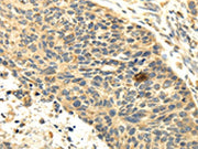 The image on the left is immunohistochemistry of paraffin-embedded Human esophagus cancer tissue using CSB-PA679493(SEMA4F Antibody) at dilution 1/35, on the right is treated with fusion protein. (Original magnification: ×200)
