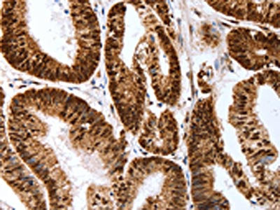 The image on the left is immunohistochemistry of paraffin-embedded Human colon cancer tissue using CSB-PA679670(Map2 Antibody) at dilution 1/40, on the right is treated with synthetic peptide. (Original magnification: ×200)
