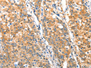 The image on the left is immunohistochemistry of paraffin-embedded Human gastic cancer tissue using CSB-PA679683(ST14 Antibody) at dilution 1/70, on the right is treated with fusion protein. (Original magnification: ×200)