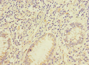 Immunohistochemistry of paraffin-embedded human colon cancer using CSB-PA679698LA01HU at dilution of 1:100