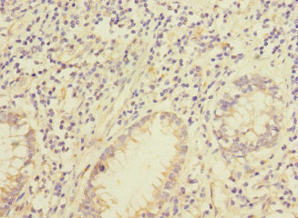 Immunohistochemistry of paraffin-embedded human colon cancer using CSB-PA679698LA01HU at dilution of 1:100