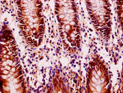Immunohistochemistry of paraffin-embedded human colon cancer using CSB-PA679703LA01HU at dilution of 1:100