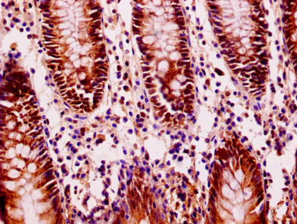 Immunohistochemistry of paraffin-embedded human colon cancer using CSB-PA679703LA01HU at dilution of 1:100