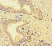Immunohistochemistry of paraffin-embedded human prostate cancer using CSB-PA680179LA01HU at dilution of 1:100