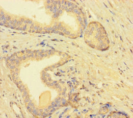 Immunohistochemistry of paraffin-embedded human prostate cancer using CSB-PA680179LA01HU at dilution of 1:100